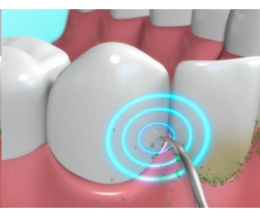 DentaPic Sonic - zářivě bílé zuby jako od profesionálů